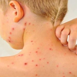 Болит голова сыпь температура